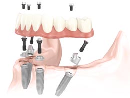 Teeth in a Day